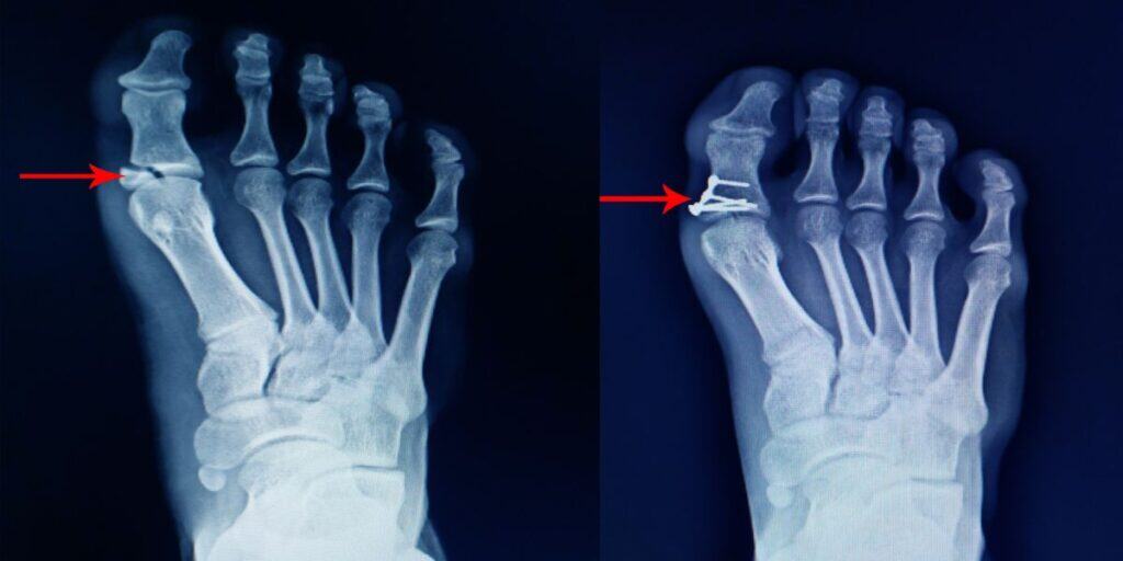 Is Cosmetic Foot Surgery Safe Or Are You Starting Off on the Wrong Foot