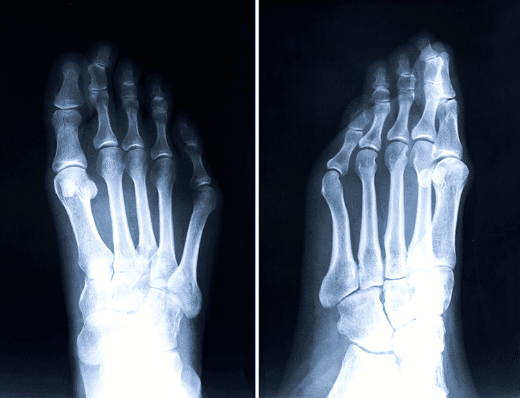 tailors bunion