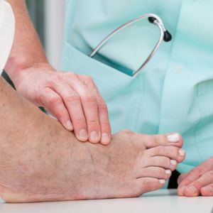 Bunions