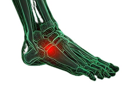 Accessory navicular, los angeles