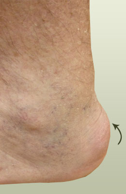 Achilles-spur-prior-to-removal