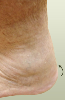 Achilles-spur-removed