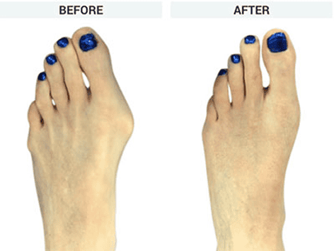 Bunionplasty before and after Image from Dr. Bob Baravarian