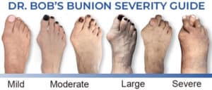Stages of a bunion, Bunion Surgeon Los angeles