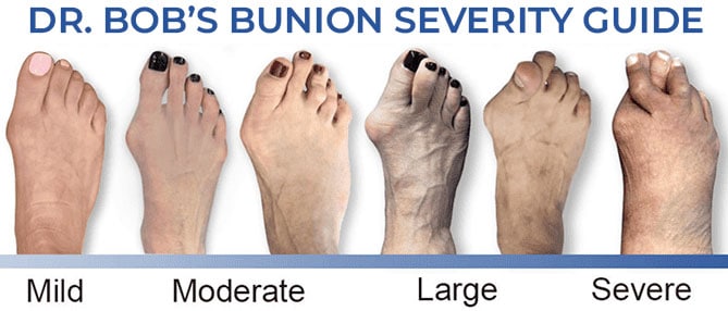 Stages of a bunion, Bunion Surgeon Los angeles