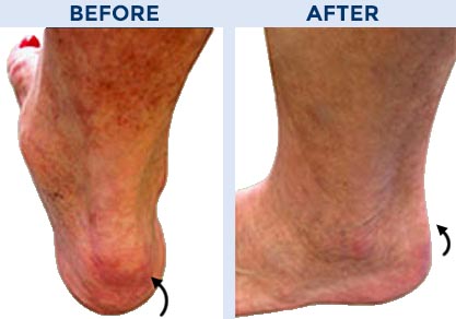 Achilles Surgery Before and After Pictures