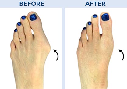Achilles Surgery Before and After Pictures