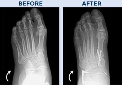 Flat Foot Before and After Pictures