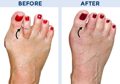 Toe Correction Before and After Pictures