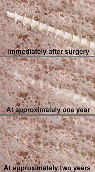 Ossio fiber progression