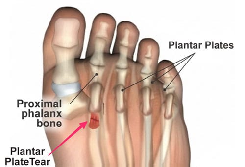 Plantar plate tear, Los Angeles Podiatrist