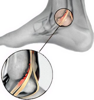 posterior-tibial-tendonitis