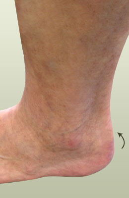 achilles-spur-post-2