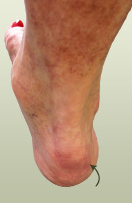 Tenex Procedure