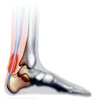 Achilles Tendon Rupture