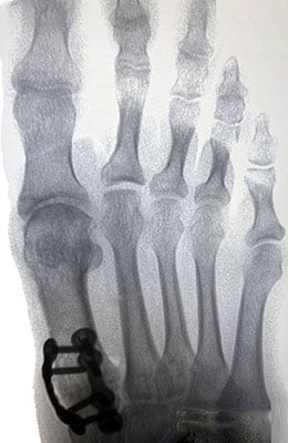 B Union Incision Bunion Surgery Before & After Pictures - Dr. Bob Baravarian