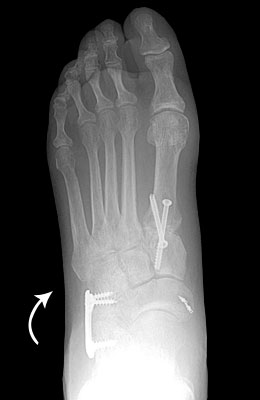 flat-foot-post