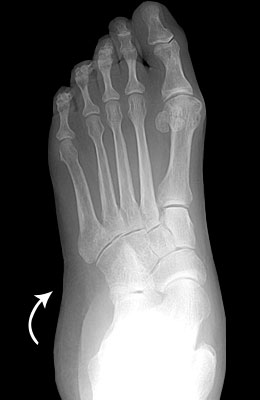 flat-foot-pre