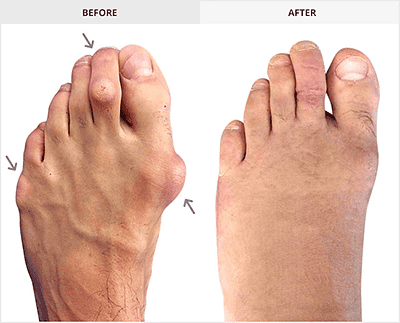 before-after-feet