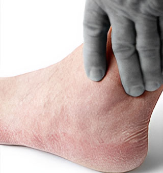 Ankle Arthritis