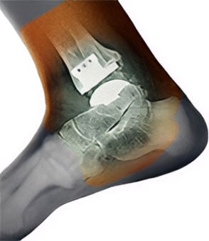 Ankle Replacement