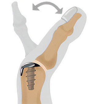 Arthrosurface