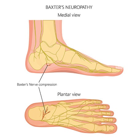 Baxter Nerve Entrapment