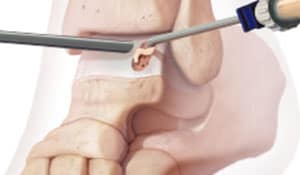 Biocartilage-Inner2