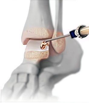 Cartilage Transplant for Osteochondral Lesion