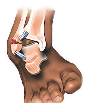 Broken Ankle