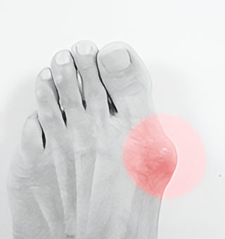 Bunionplasty
