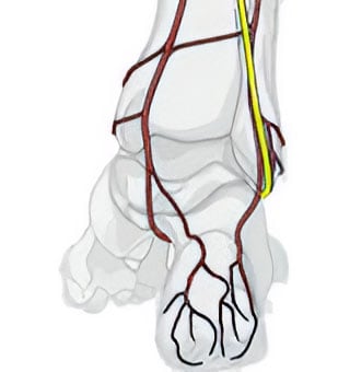 Calcaneal Nerve Entrapment