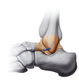 InternalBrace for Chronic Ankle Instability