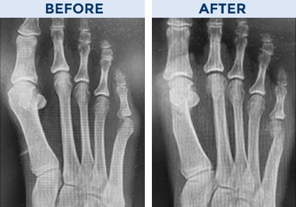 ghost bunionectomy before and after image
