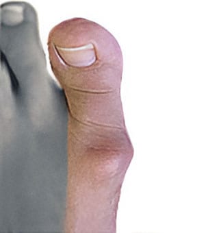 Hallux Rigidus