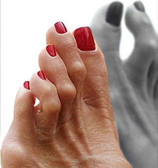 Hammertoes