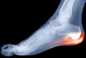 Heel Nerve Entrapment 300-University Foot and Ankle Institute