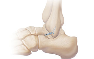 heel pain