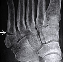 Jones-Fracture-7