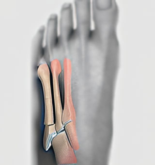 Jones Fracture