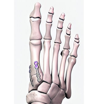 Lapiplasty 3D Bunion Repair