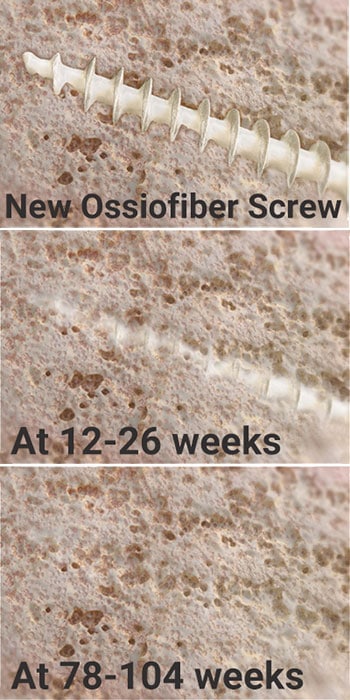 Ossio-screw-progrssion