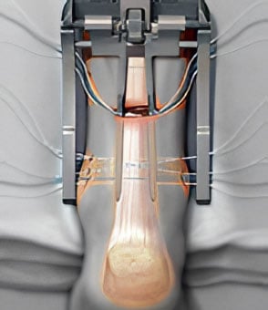 PARS for Achilles Rupture