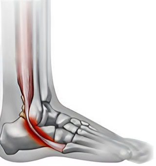 Peroneal Tendon Tear