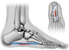 Plantar-Fibromas-2