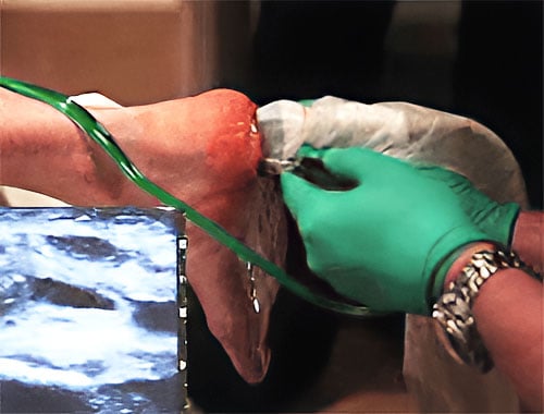 Tenex Procedure