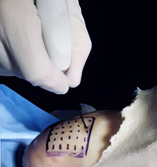 Topaz Procedure