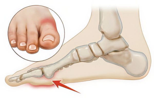 Turf Toe illustration