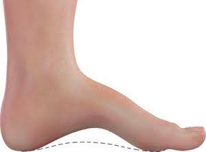 cavus foot