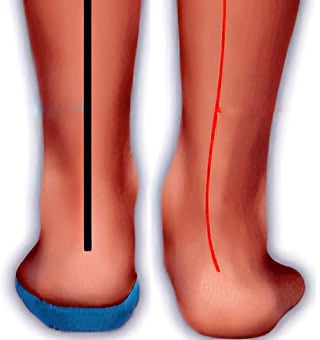 Custom Orthotics